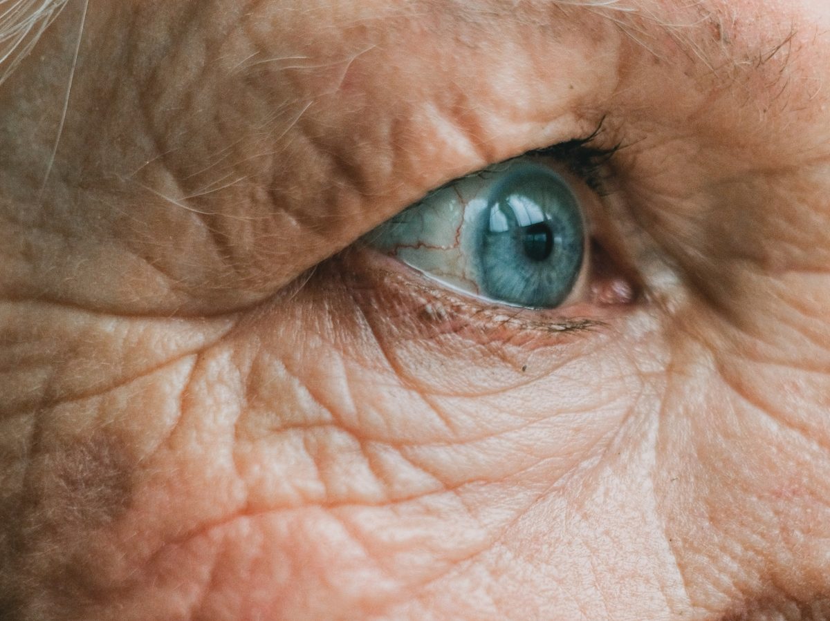 Blepharoplasty (Eyelid Surgery)